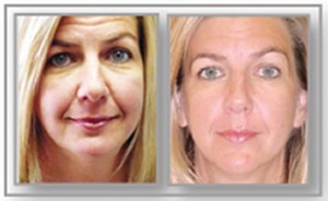 Anti-Aging: Before and After Facial Treatment