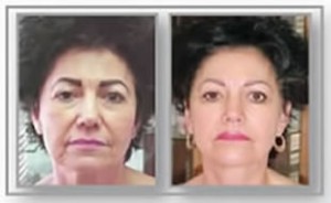 Anti-Aging Facial Treatment Before and After