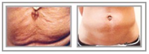 Anti Aging Tummy Before and After