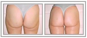 Anti-Aging Buttocks Before and After